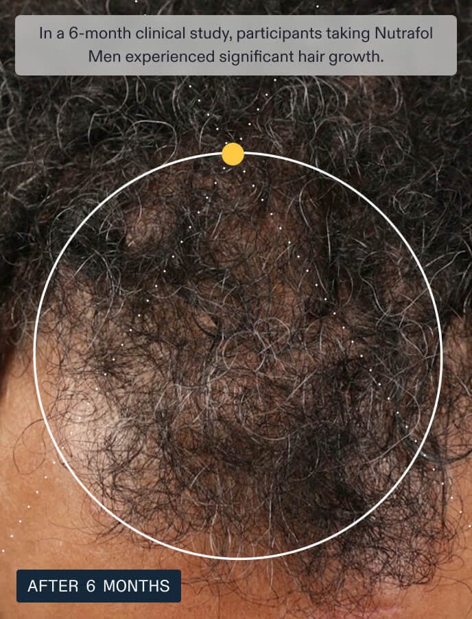 In a 6-month clinical study, participants taking Nutrafol Men experienced significant hair growth.