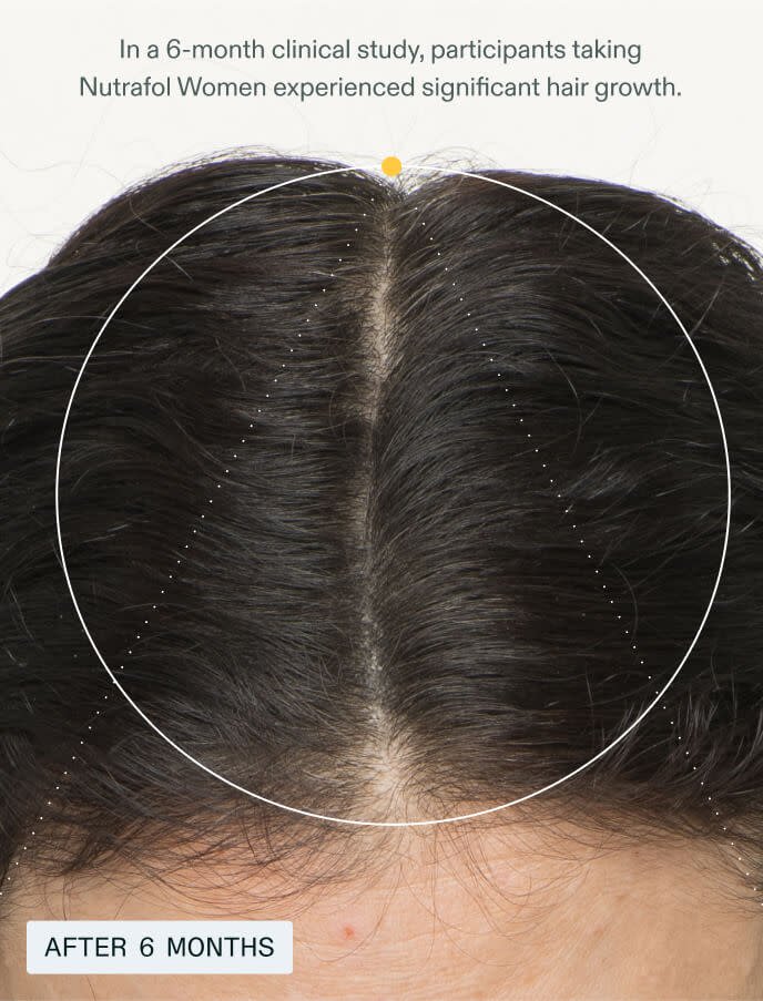 After - In a 6-month clinical study, participants taking Nutrafol Women experienced significant hair growth.